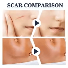 Scar comparison showcasing before and after results of skin treatment with Pura Neve spray energizante.